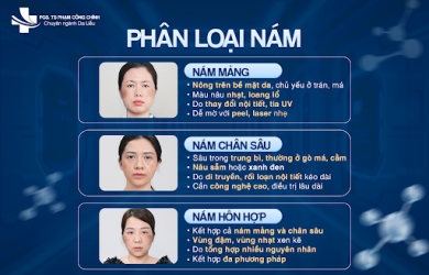 Phân biệt các loại nám và cách điều trị hiệu quả